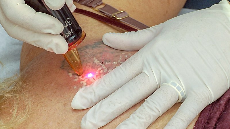 5 Things You Should Know about Tattoo Removal in Advance